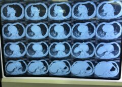 KGMU Doctors Successfully Perform Rare Thoracoscopic Surgery on 11-Month-Old Infant